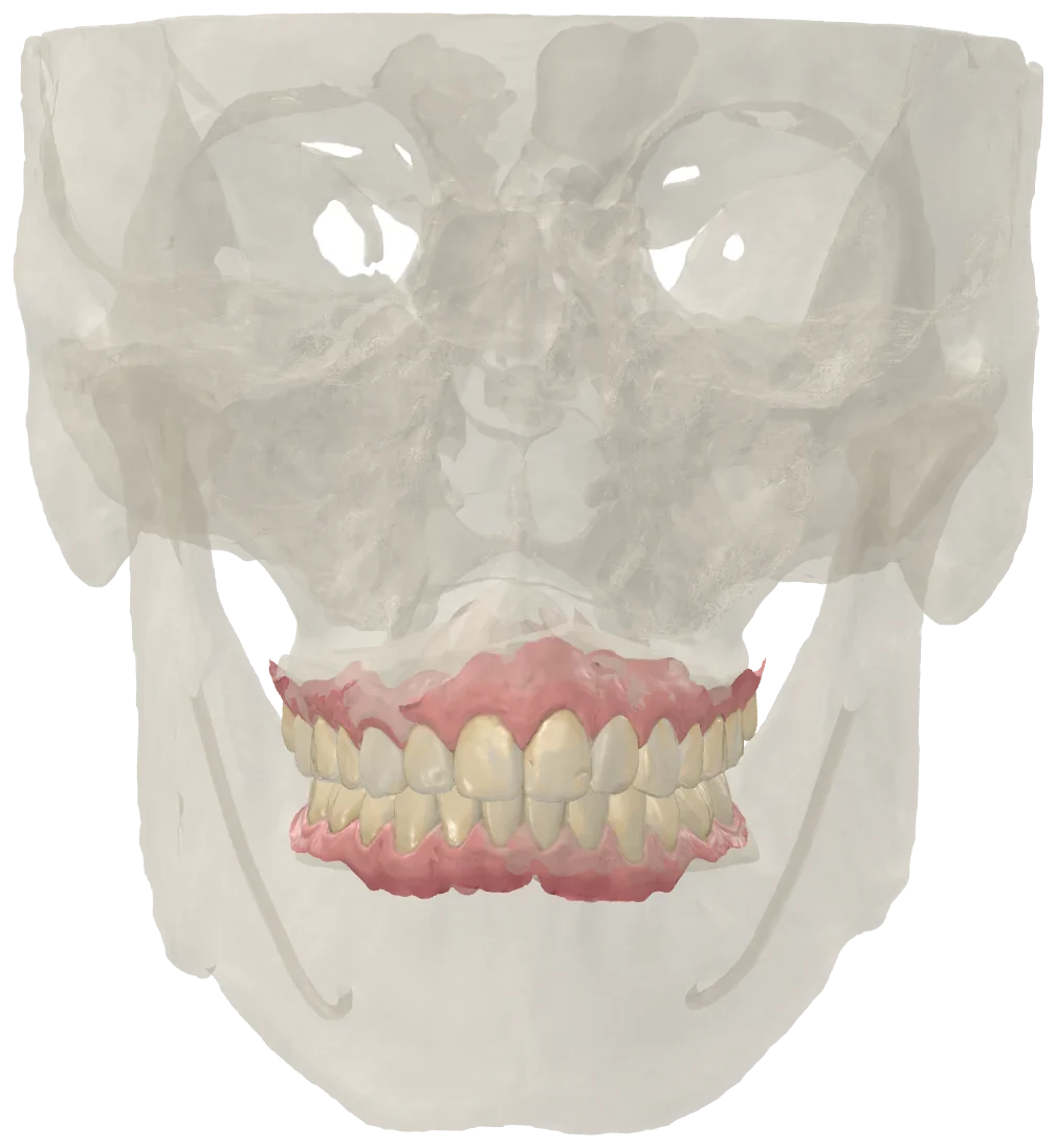 Escáneres intraorales con la malla del cráneo de un CBCT, solo para verla