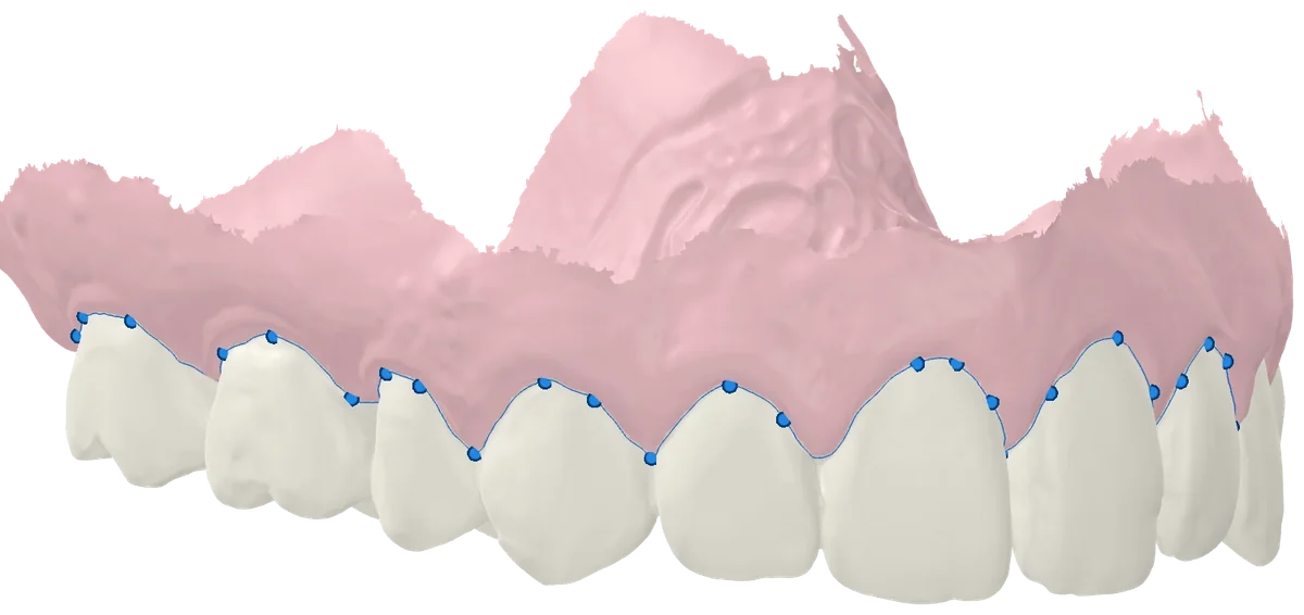 Margen gingival con sus puntos editables
