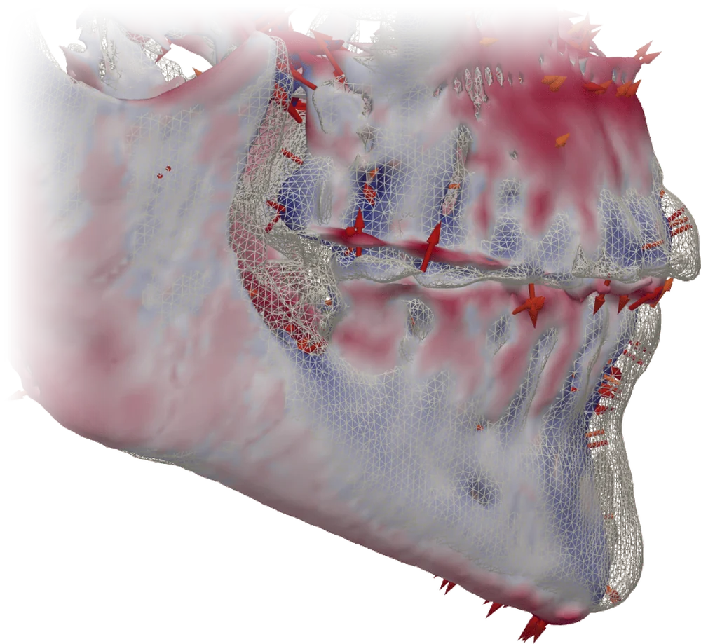 tresD DICOM: superposición de dos CBCT con mapa de color y flechas
